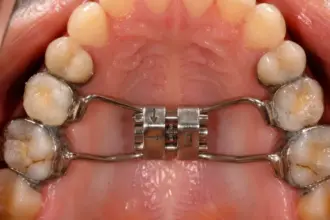 A detailed view of an arch expander adults showing the screw mechanism