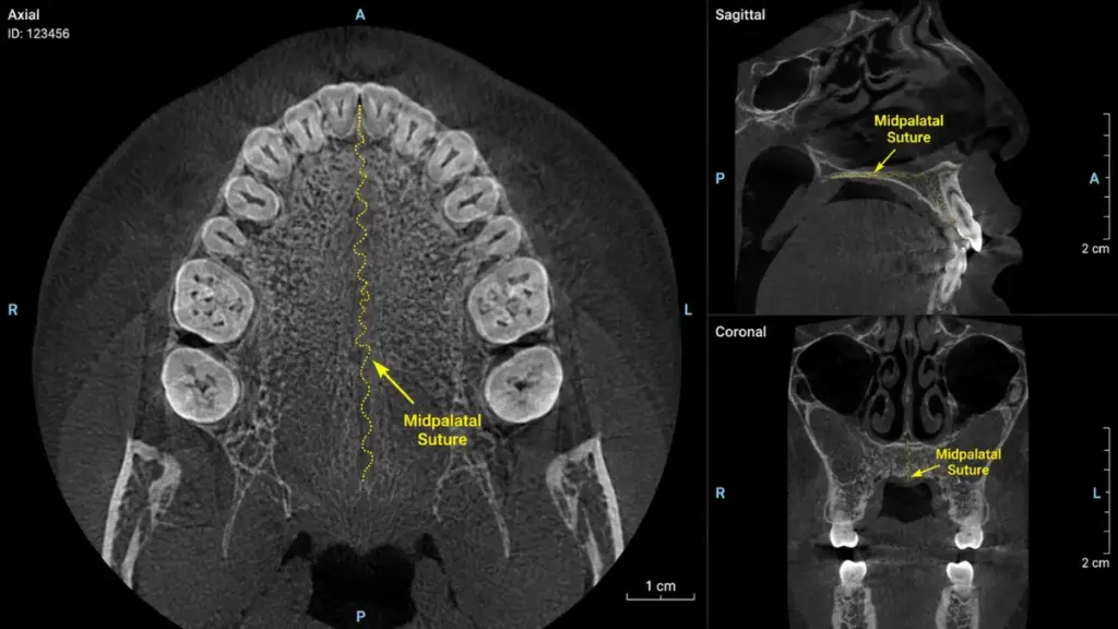 Pre-treatment diagnostic for an arch expander adults procedure.