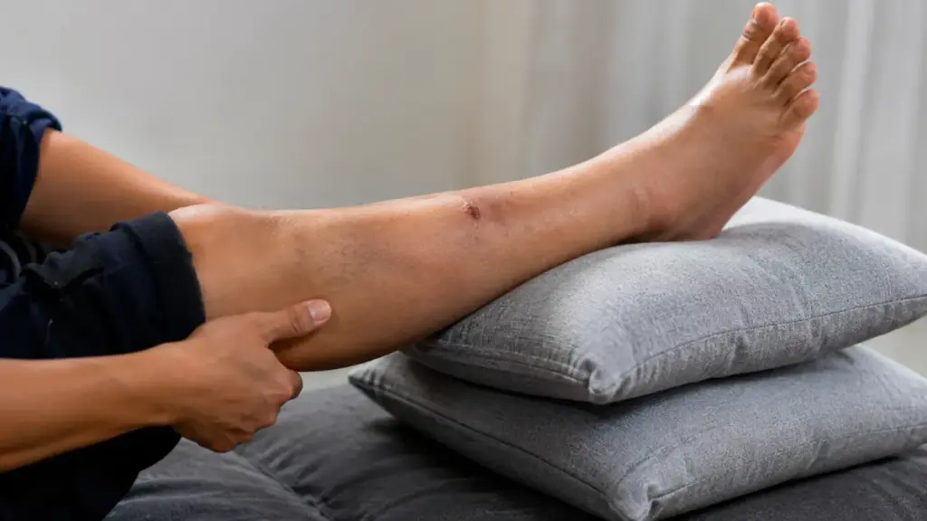 elevating-a-swollen-leg-on-pillows-to-recover-from-a-snake-bite-injury