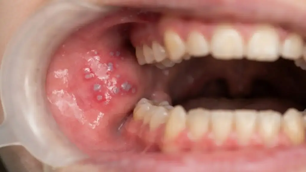 measles-symptoms-koplik-spots-oral-cavity-detail