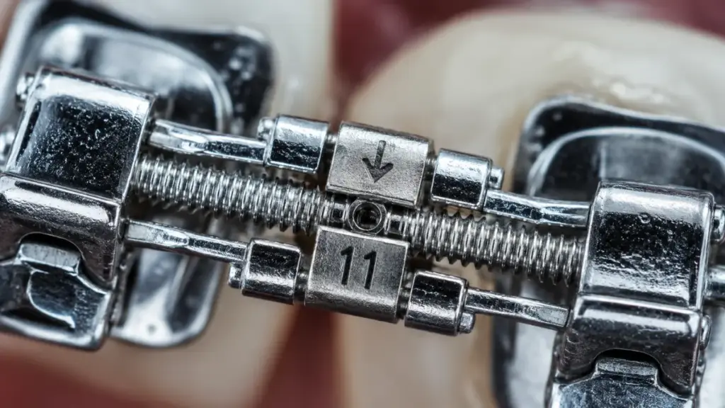 metallic screw mechanism of palate expanders