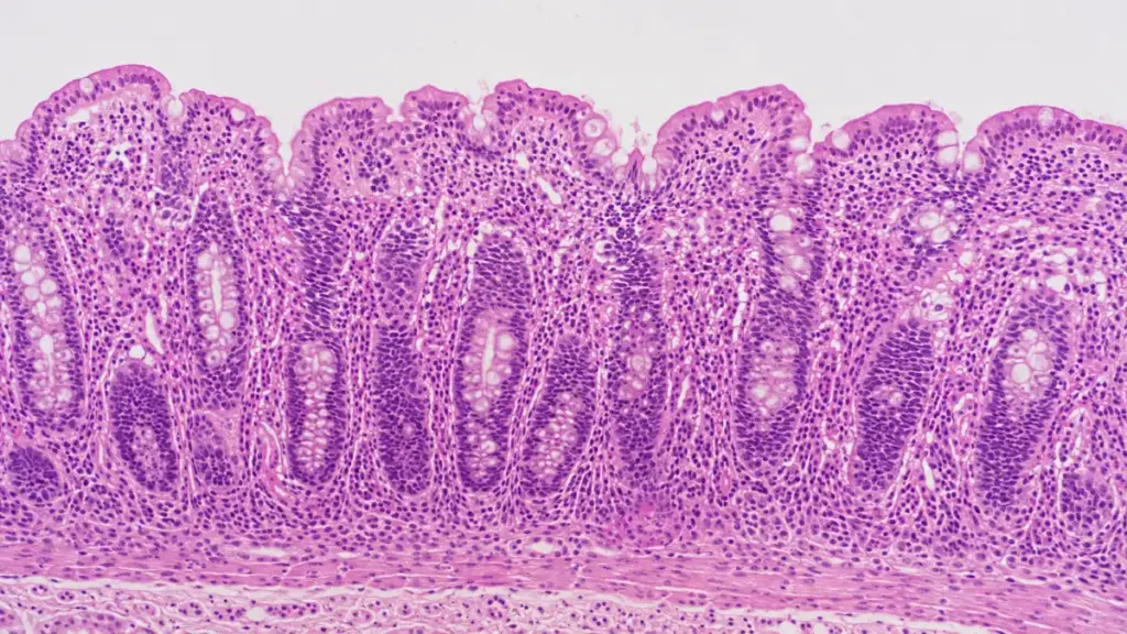 parasitic-infection-villous-atrophy-histopathology-slide