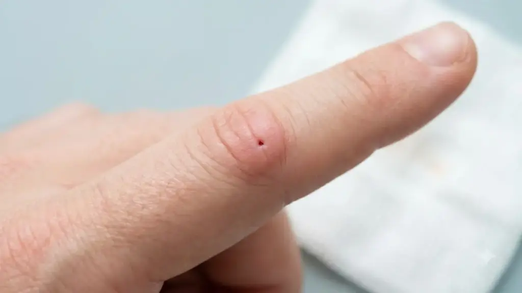 cat-bite-localized-hand-swelling-puncture-wound